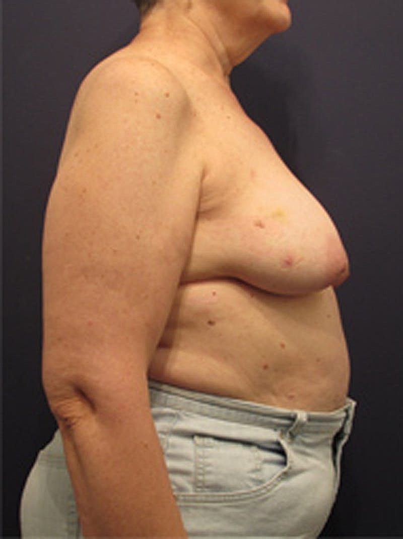 Breast Reconstruction Before & After