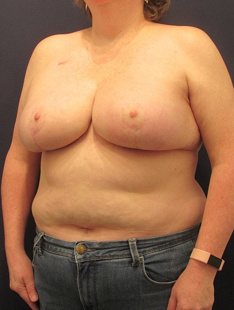 Breast Reconstruction Before & After