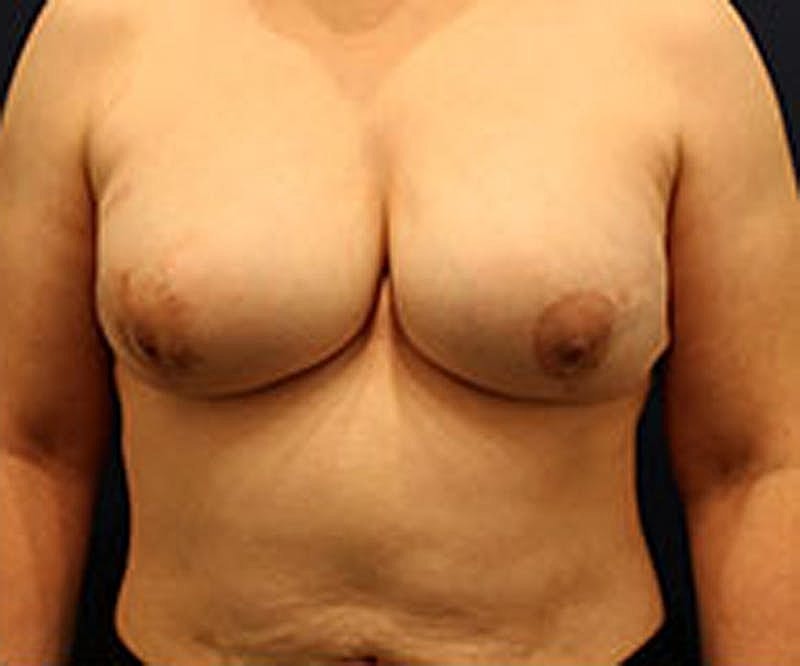 Breast Reconstruction Before & After