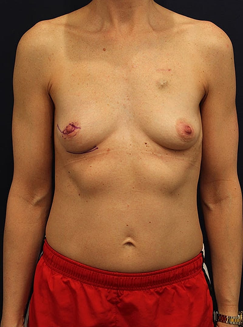 Breast Reconstruction Before & After