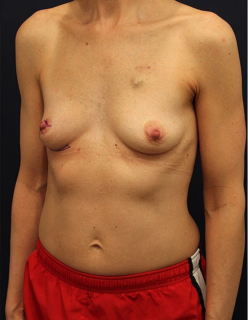 Breast Reconstruction Before & After
