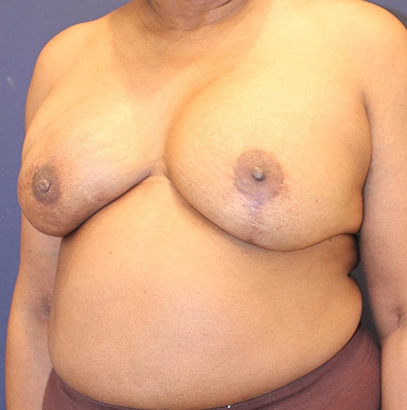 Breast Reconstruction Before & After