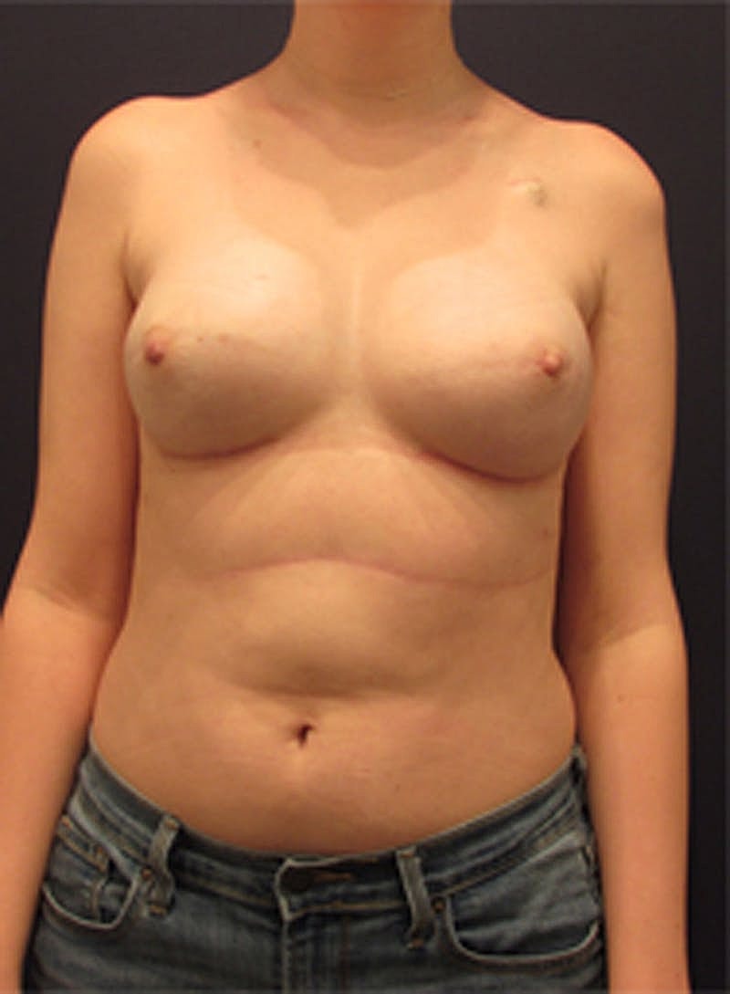 Breast Reconstruction Before & After