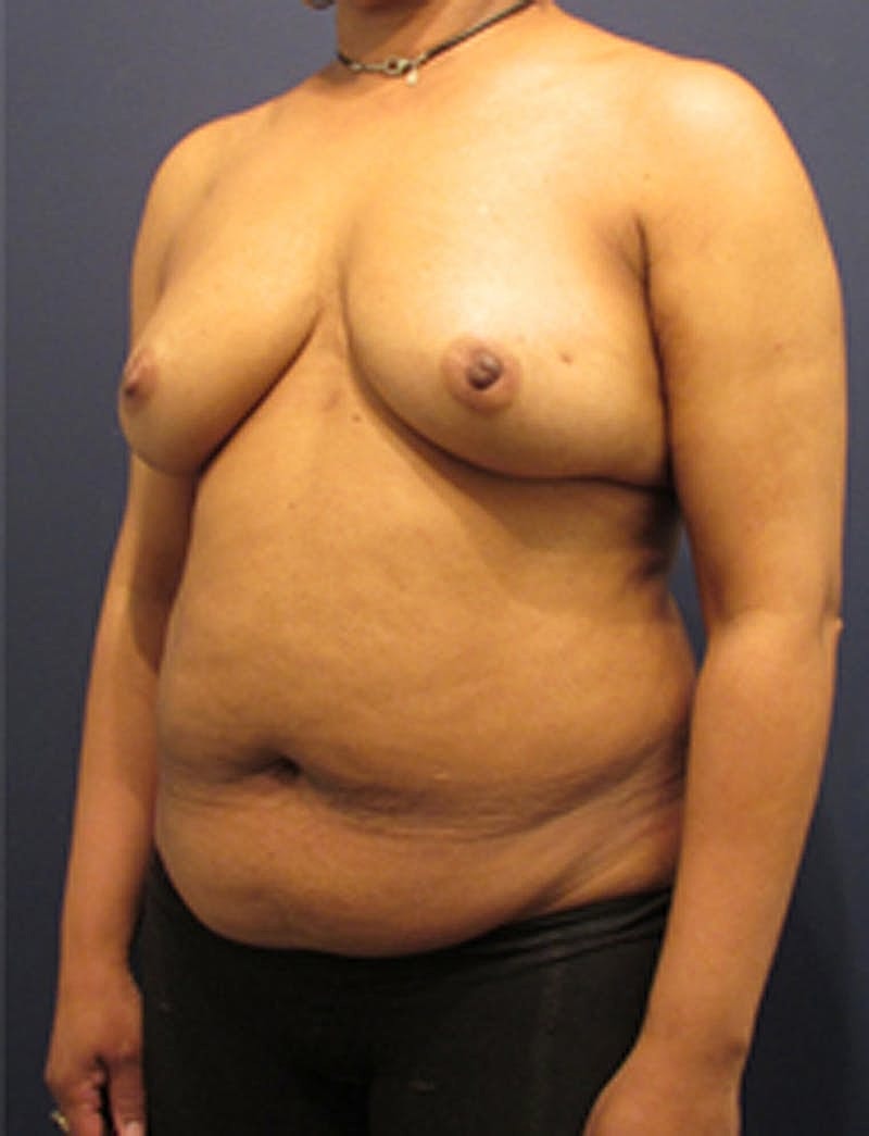 Breast Reconstruction Before & After