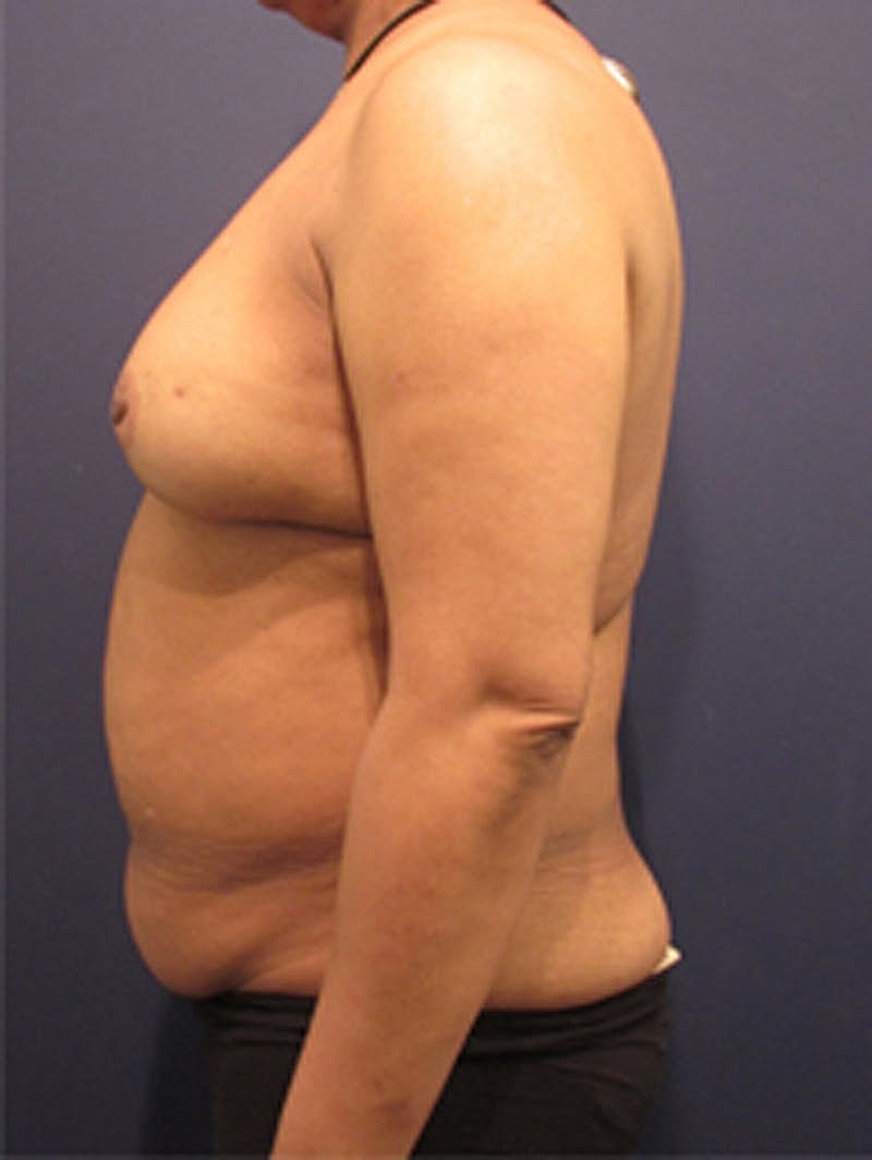 Breast Reconstruction Before & After