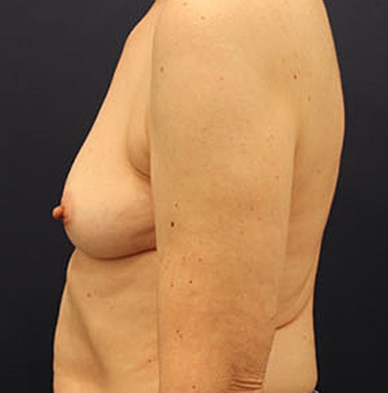 Breast Reconstruction Before & After