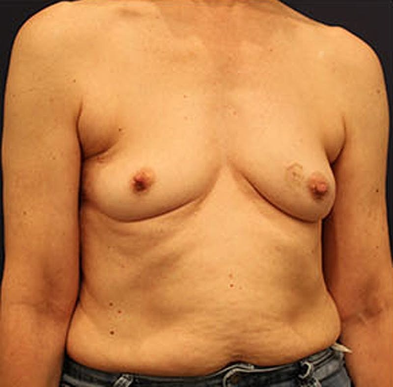 Breast Reconstruction Before & After