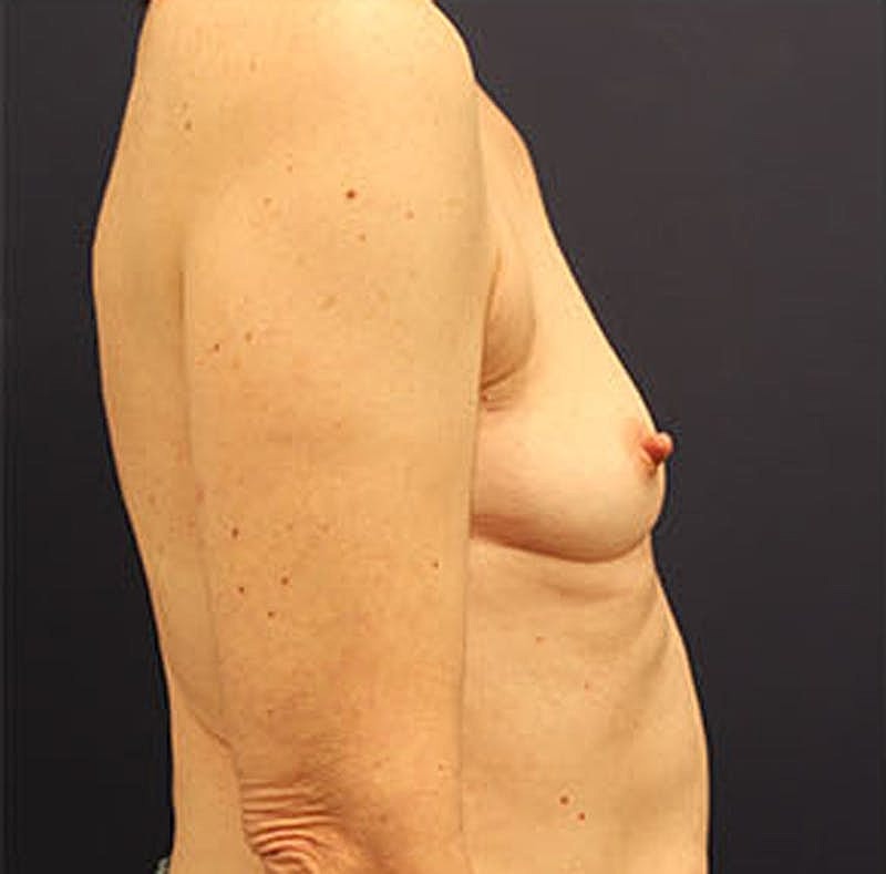 Breast Reconstruction Before & After