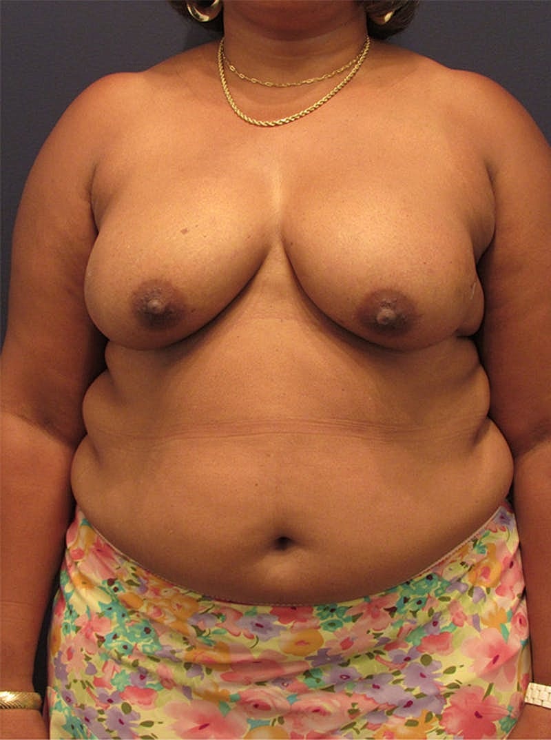 Breast Reconstruction Before & After