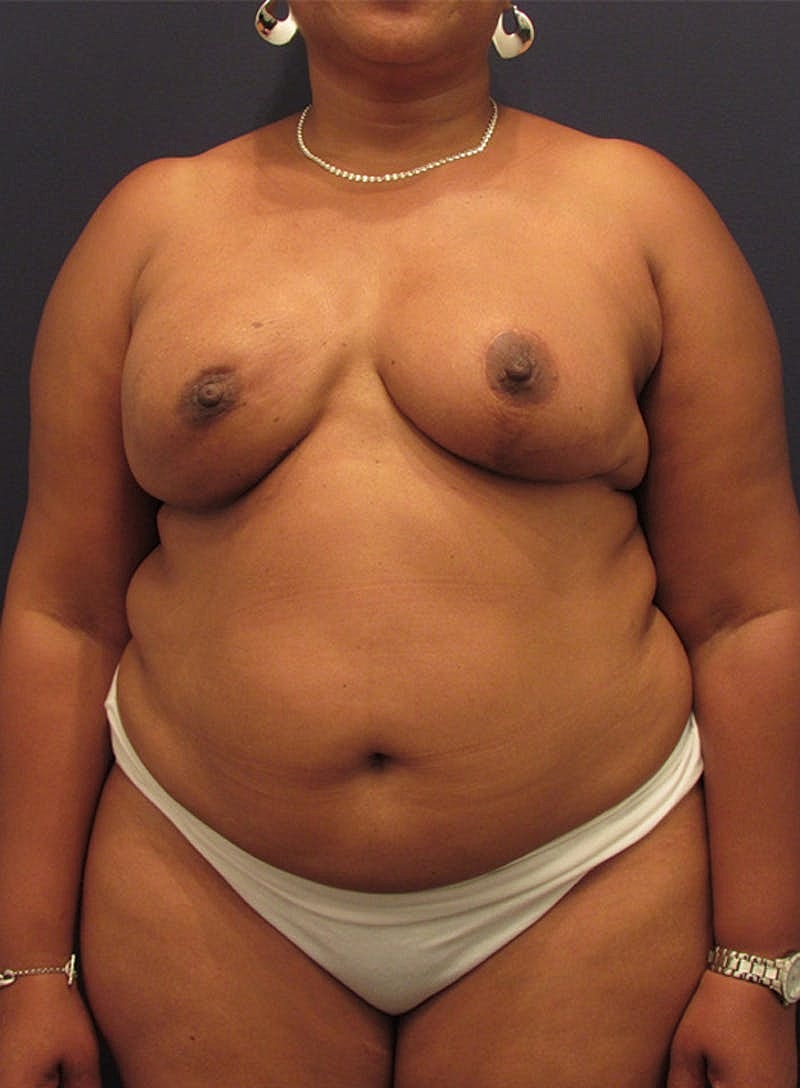 Breast Reconstruction Before & After