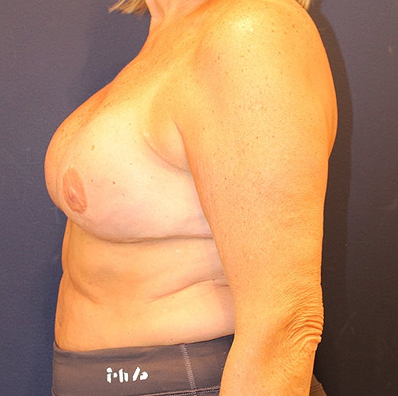 Breast Reconstruction Before & After