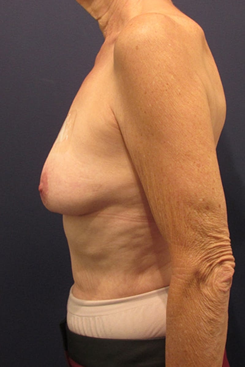 Breast Reconstruction Before & After