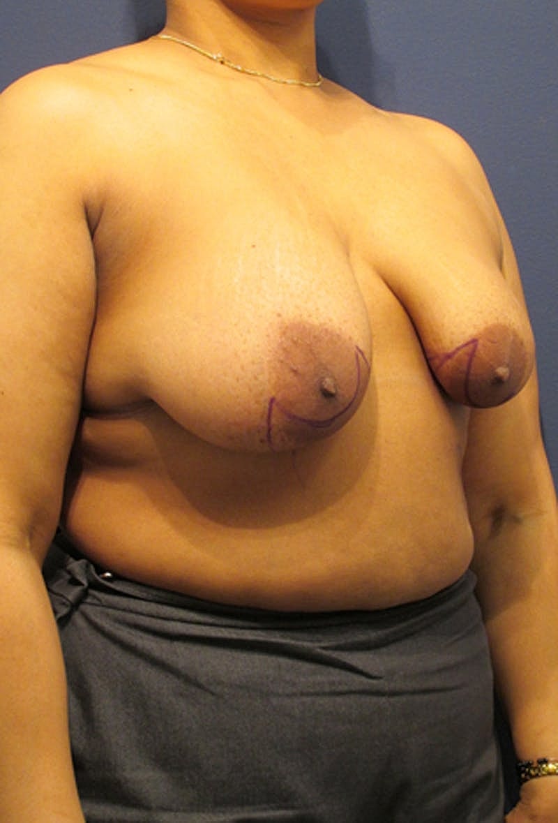 Breast Reconstruction Before & After
