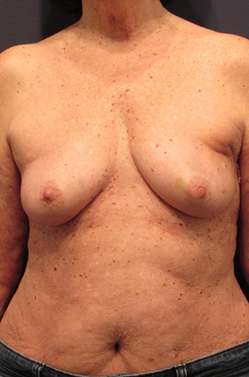 Breast Reconstruction Before & After