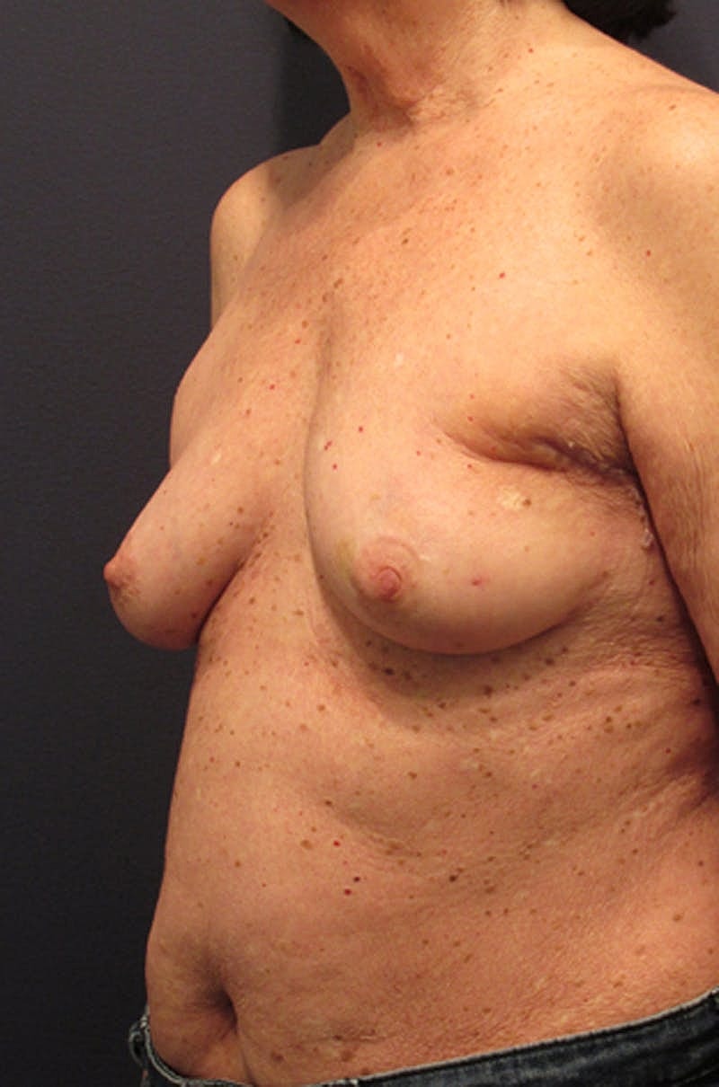 Breast Reconstruction Before & After
