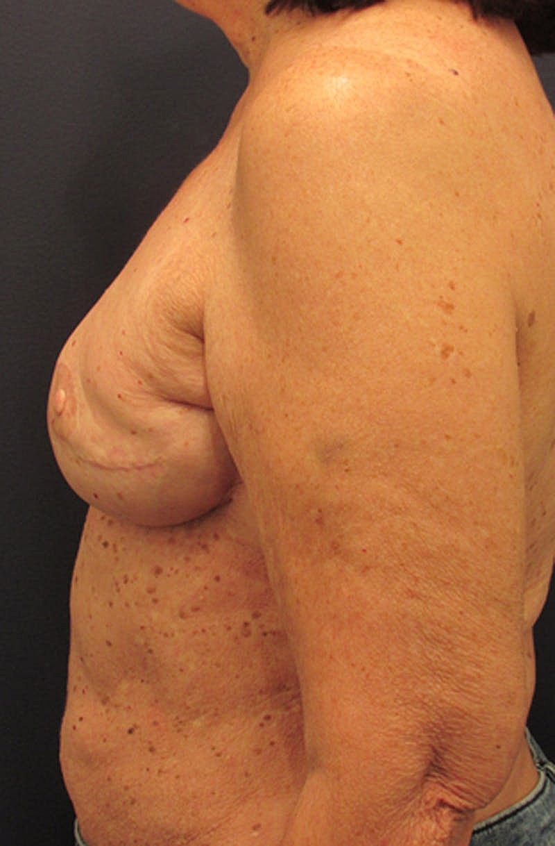 Breast Reconstruction Before & After