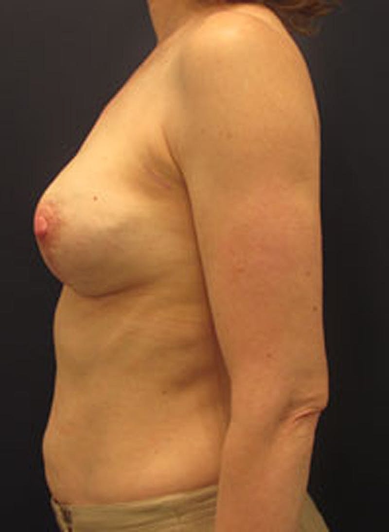 Breast Reconstruction Before & After
