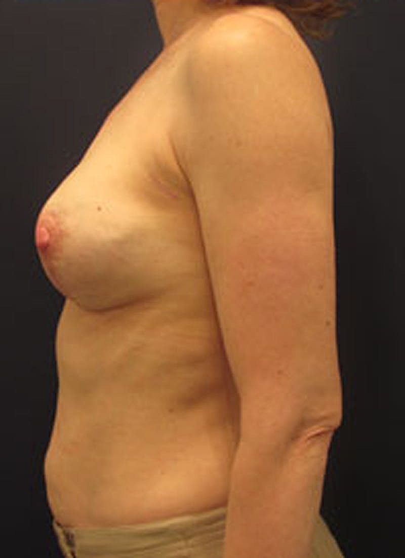 Breast Reconstruction Before & After