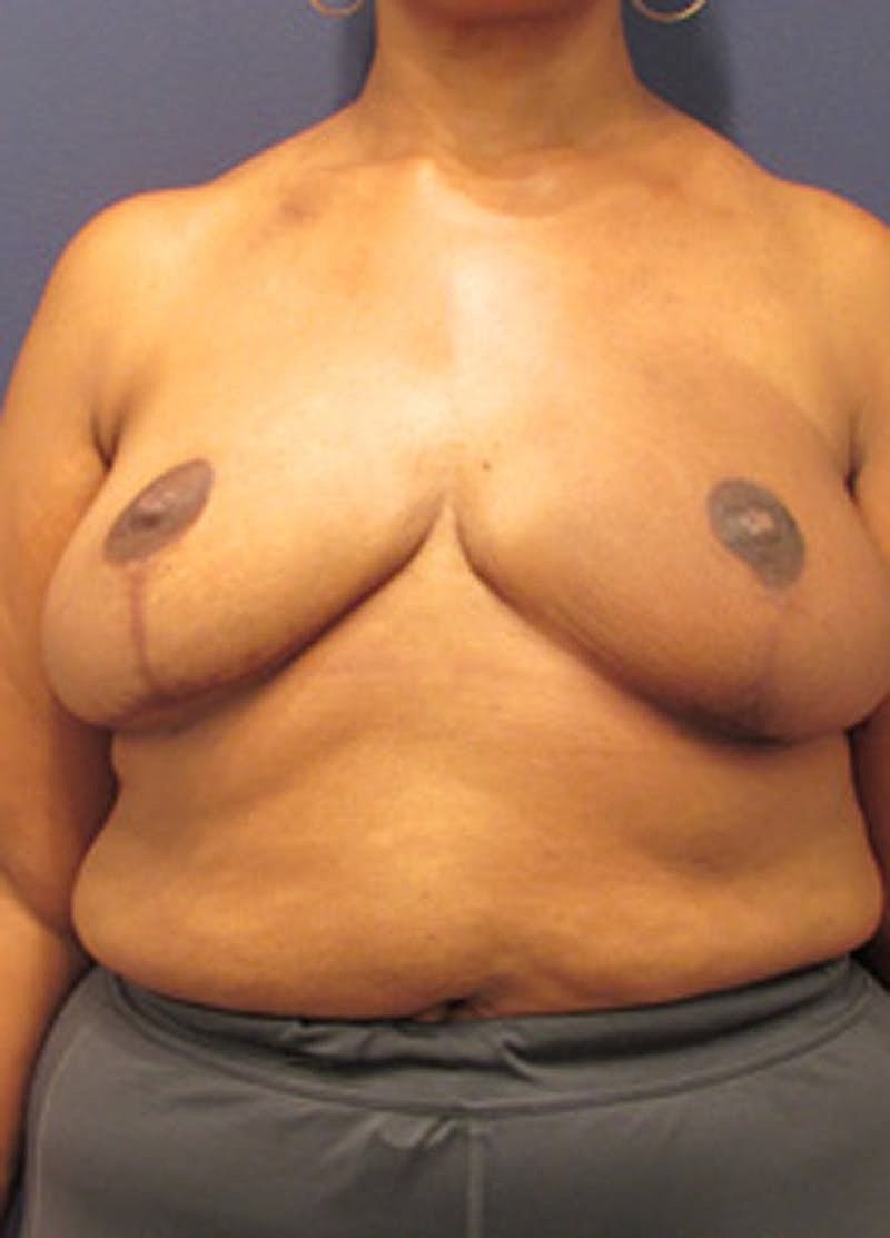 Breast Reconstruction Before & After