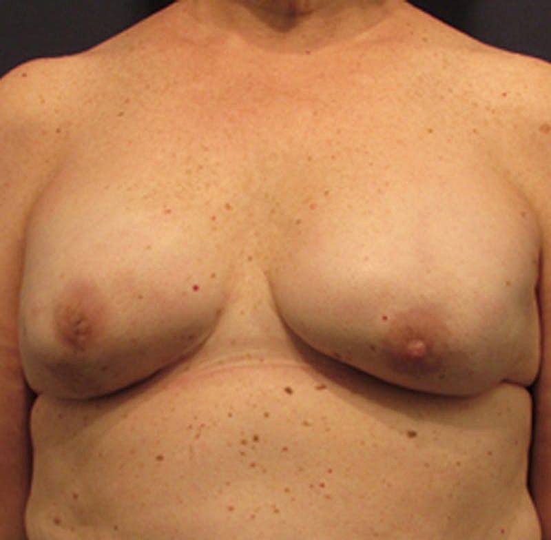 Breast Reconstruction Before & After