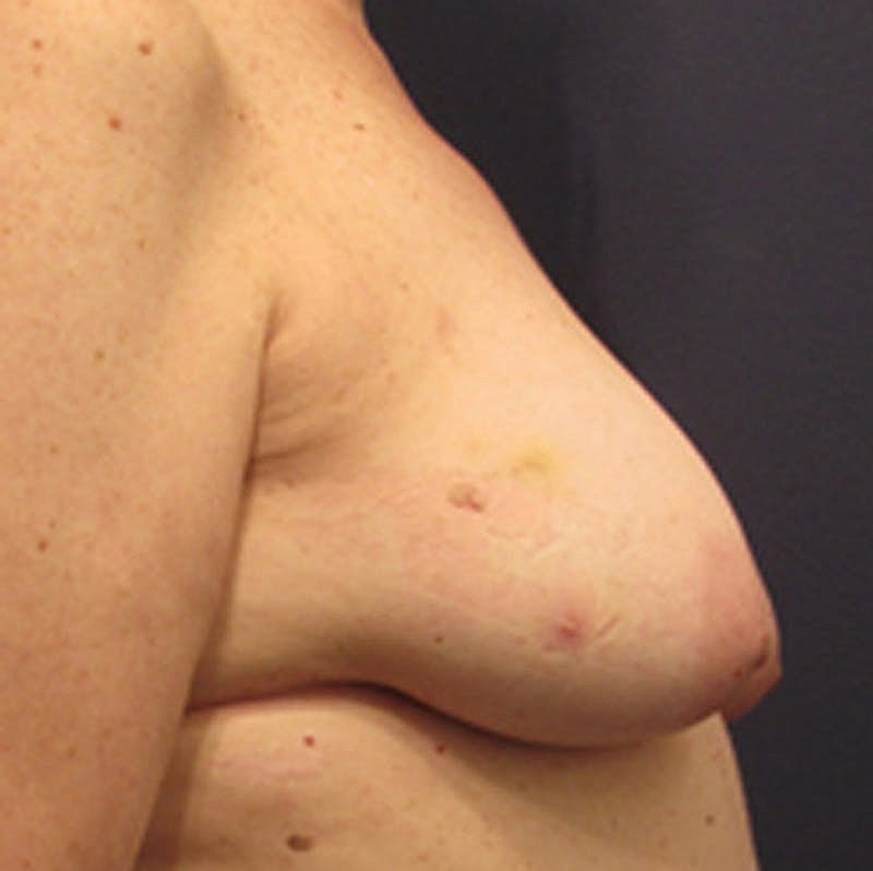 Breast Reconstruction Before & After