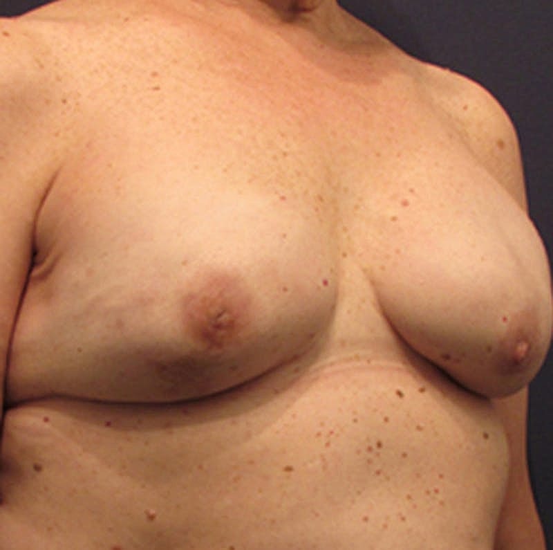 Breast Reconstruction Before & After
