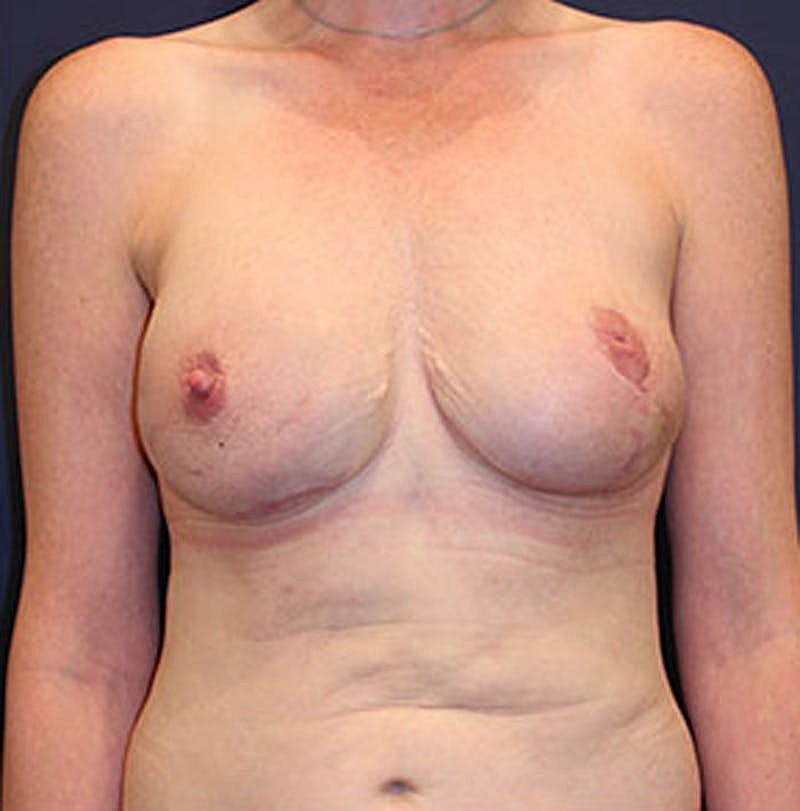 Breast Reconstruction Before & After