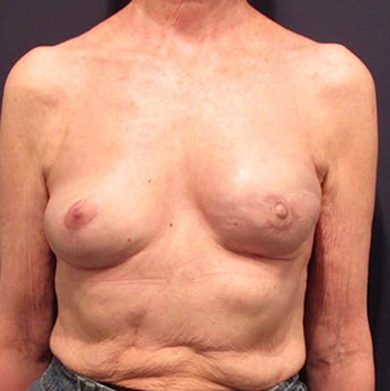 Breast Reconstruction Before & After