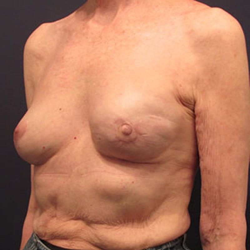 Breast Reconstruction Before & After