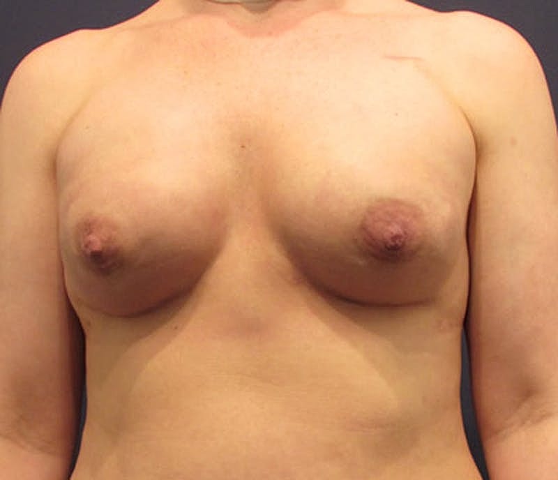 Breast Reconstruction Before & After
