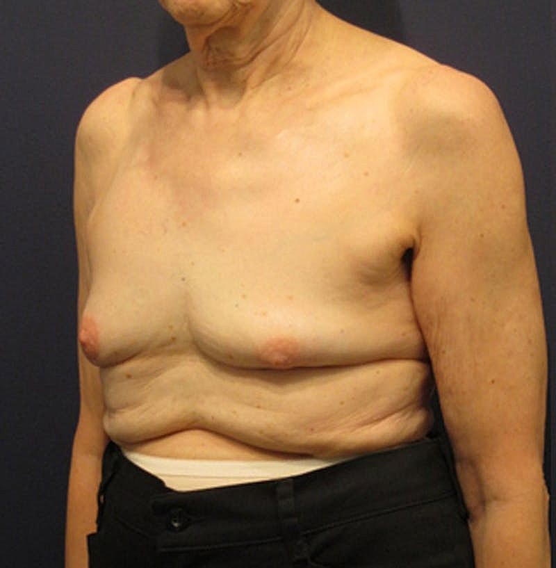 Breast Reconstruction Before & After