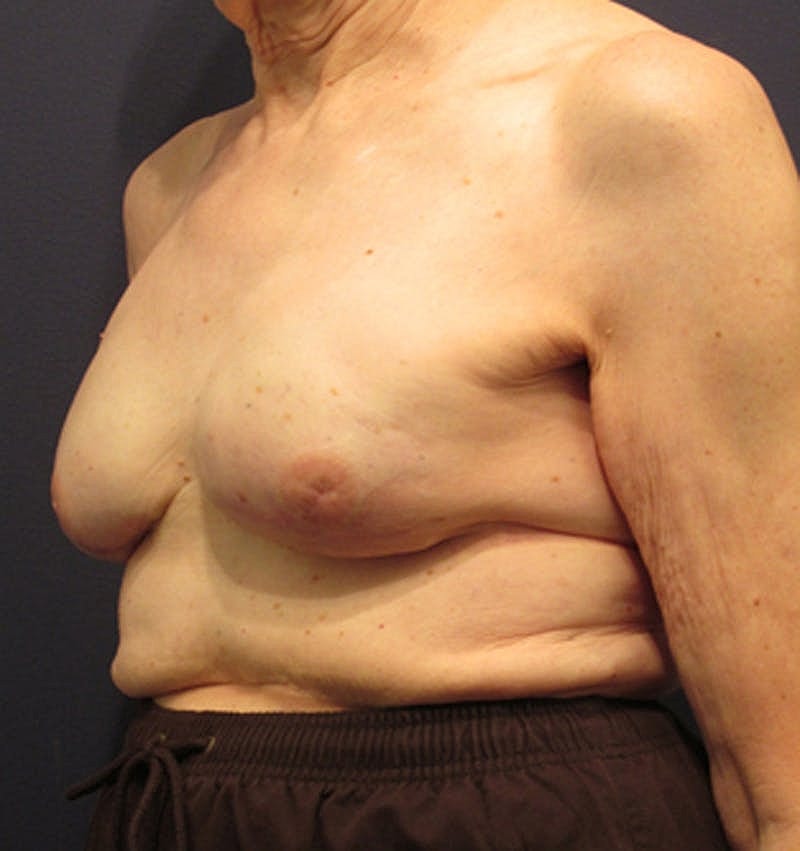 Breast Reconstruction Before & After