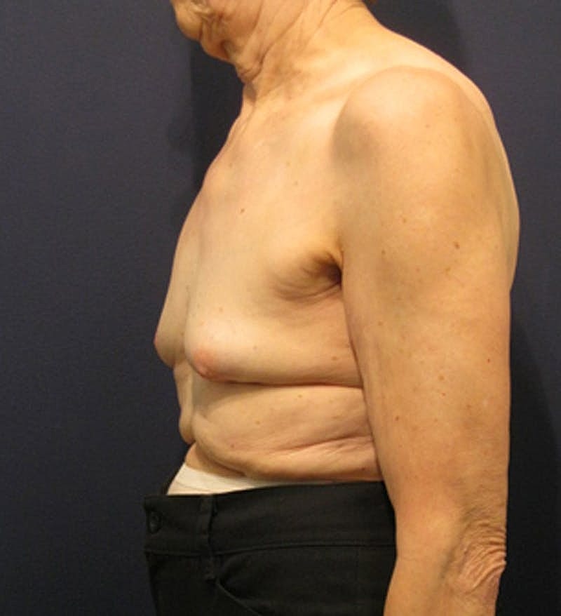 Breast Reconstruction Before & After