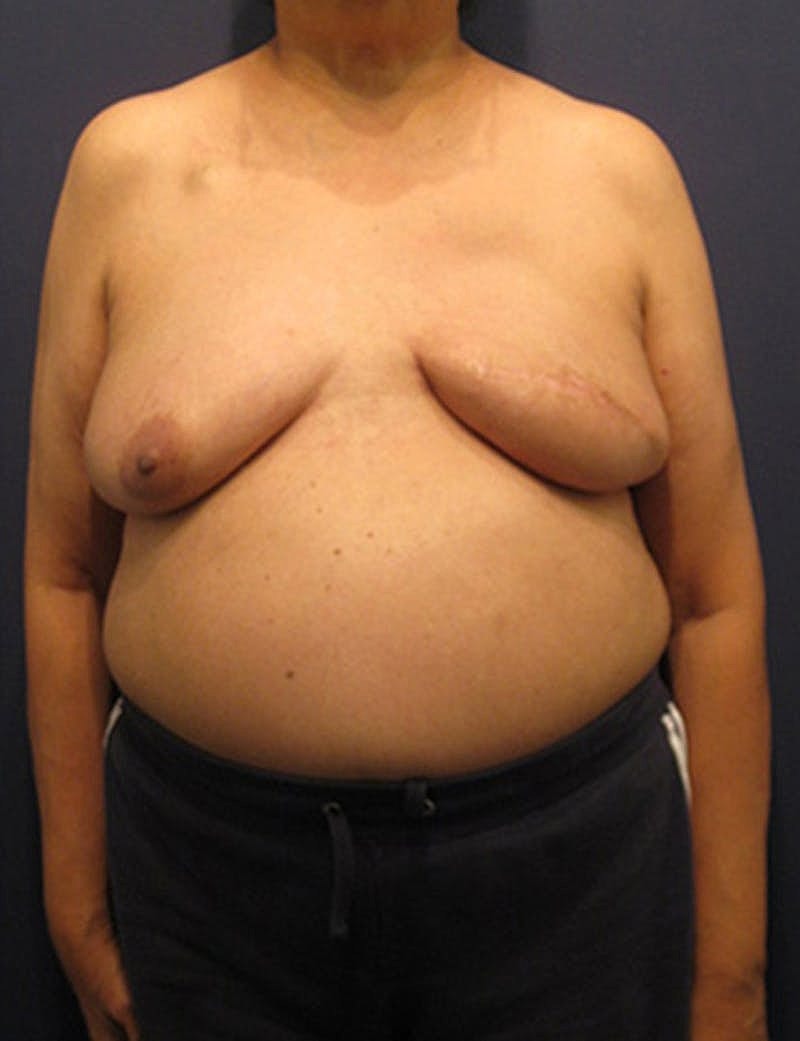 Breast Reconstruction Before & After