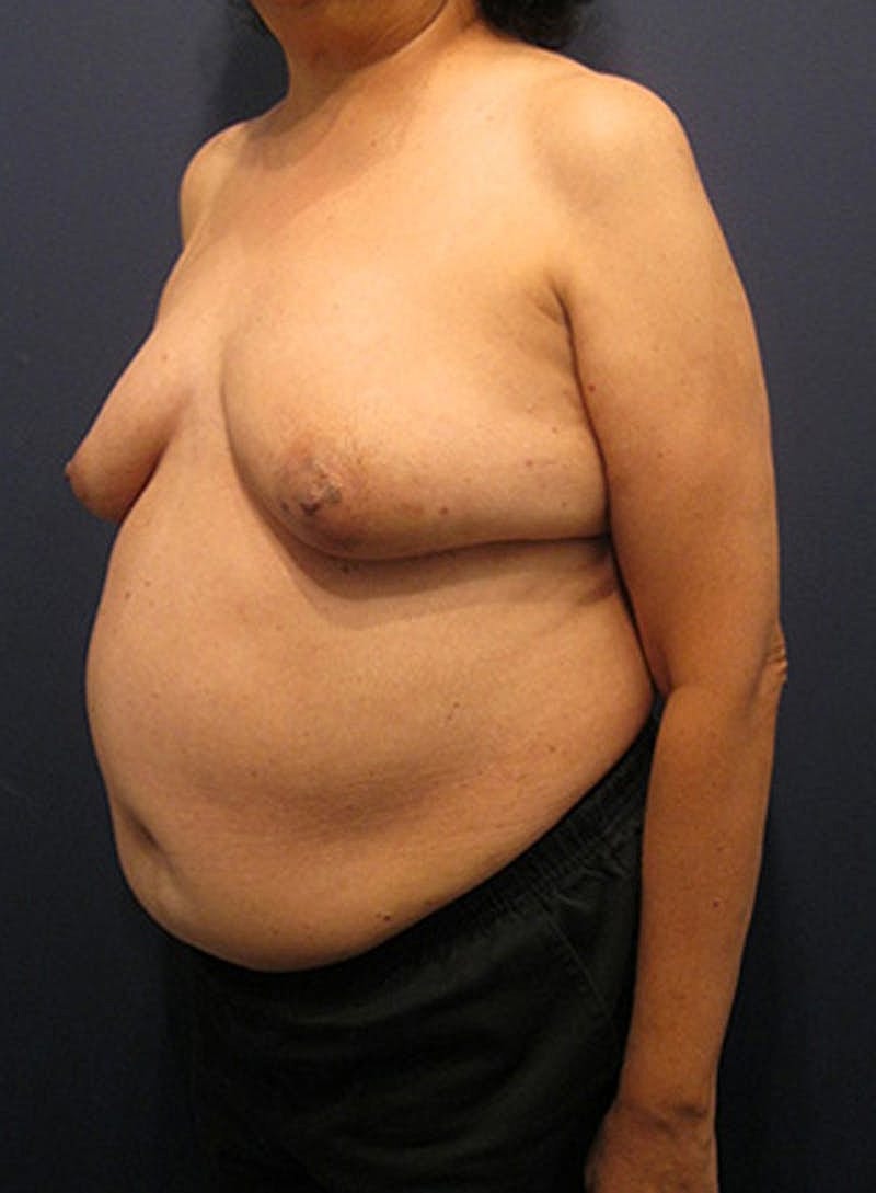 Breast Reconstruction Before & After