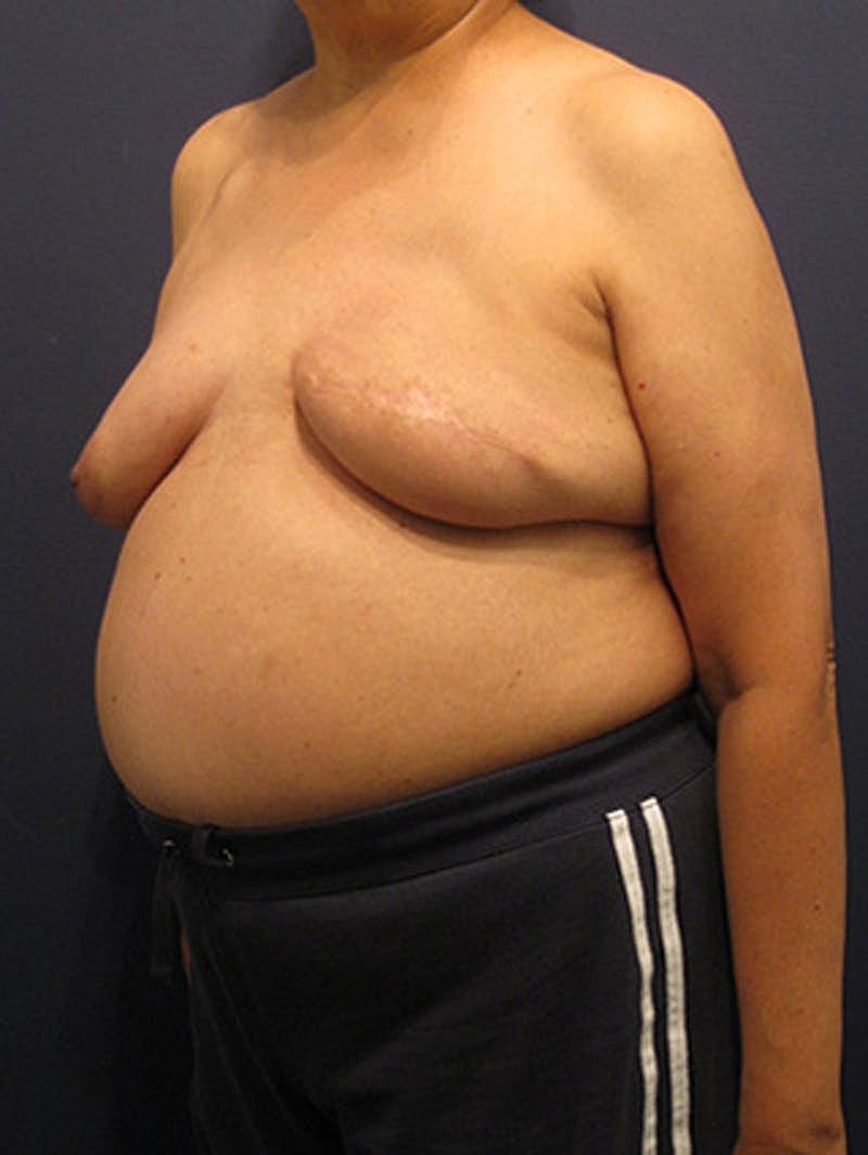 Breast Reconstruction Before & After