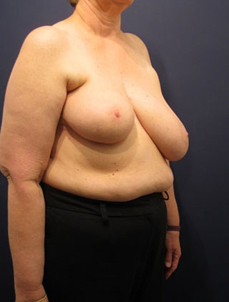 Breast Reconstruction Before & After