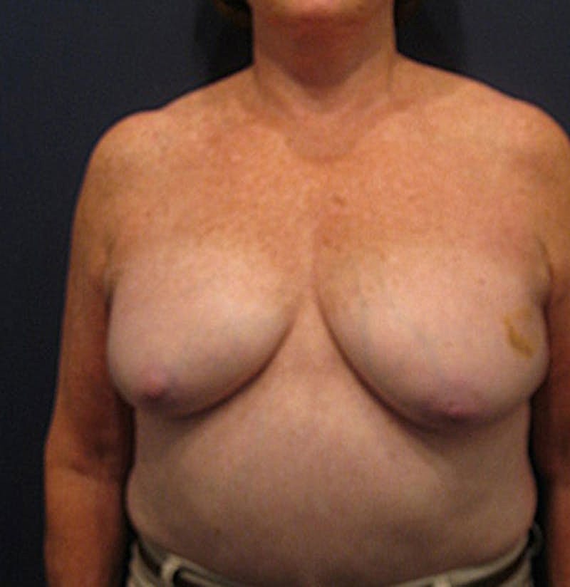 Breast Reconstruction Before & After