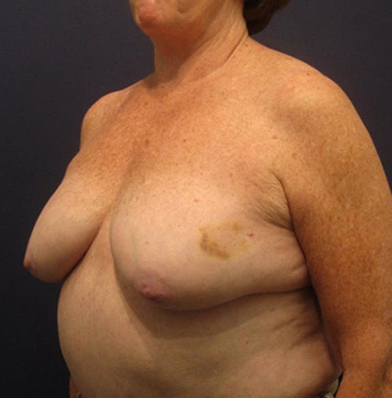 Breast Reconstruction Before & After