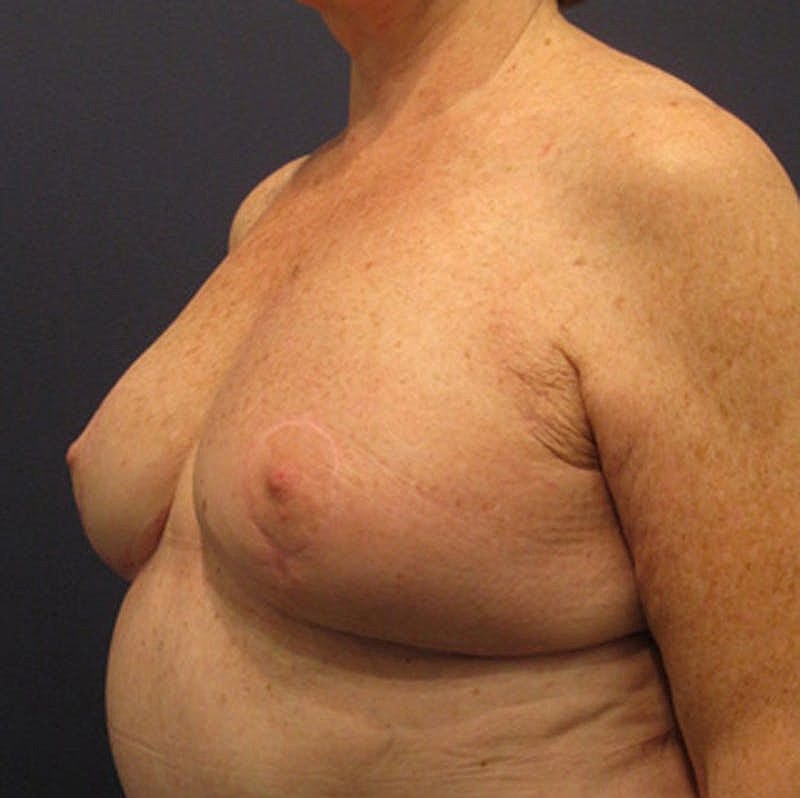Breast Reconstruction Before & After