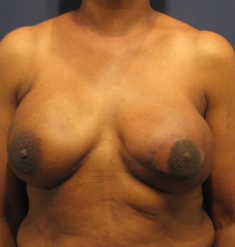 Breast Reconstruction Before & After