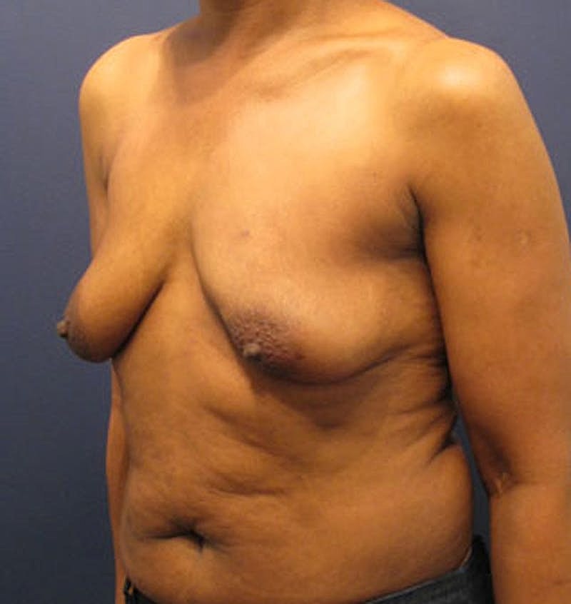 Breast Reconstruction Before & After