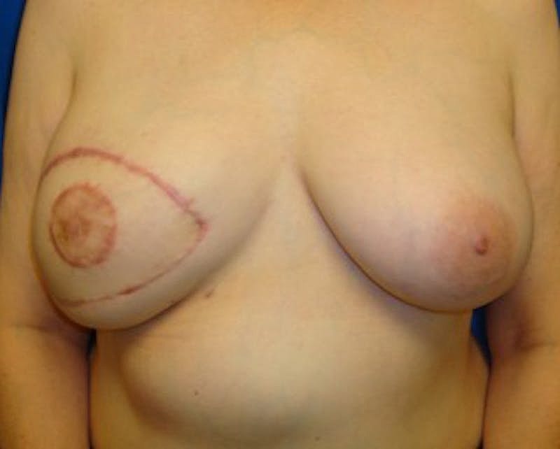 Breast Reconstruction Before & After