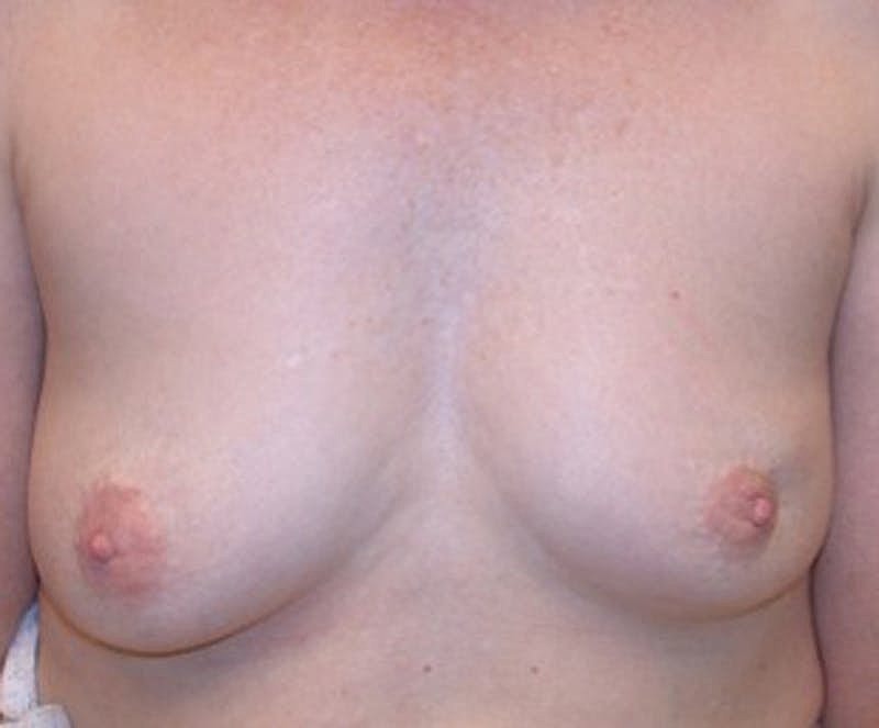 Breast Reconstruction Before & After