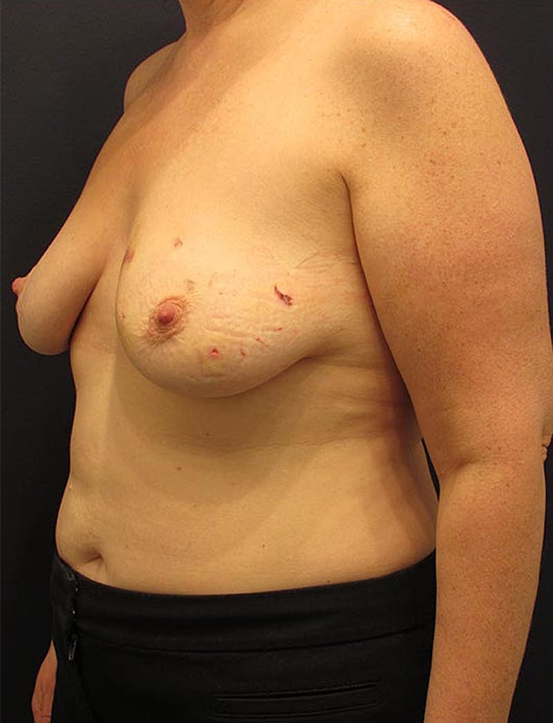 Breast Reconstruction Before & After