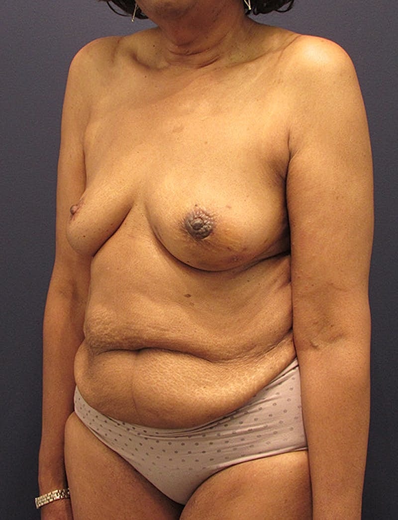 Breast Reconstruction Before & After