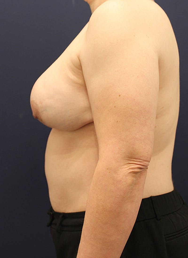 Breast Reconstruction Before & After