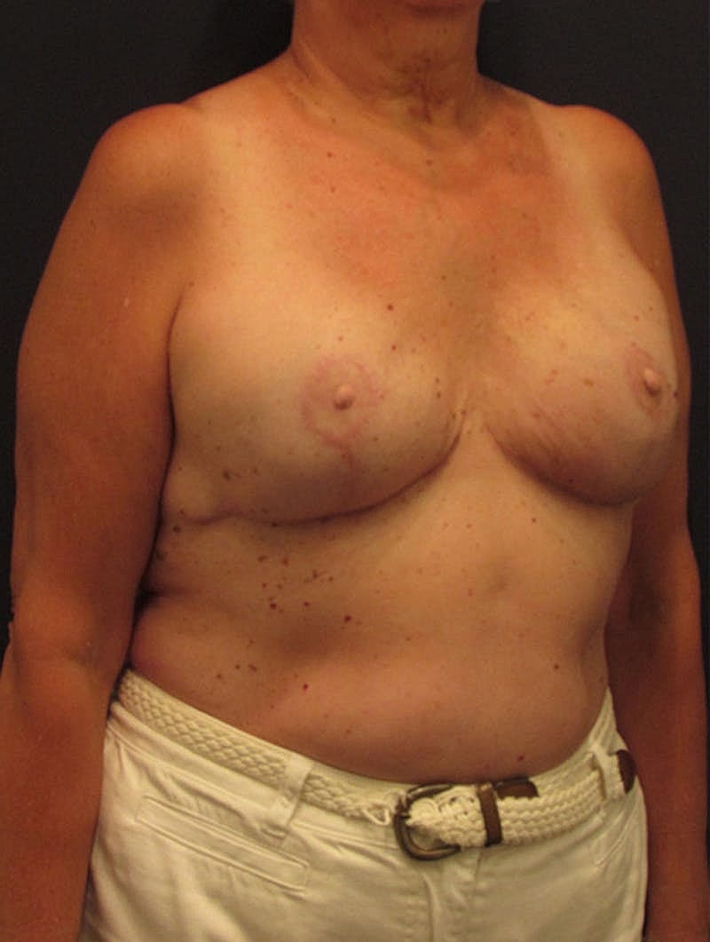 Breast Reconstruction Before & After