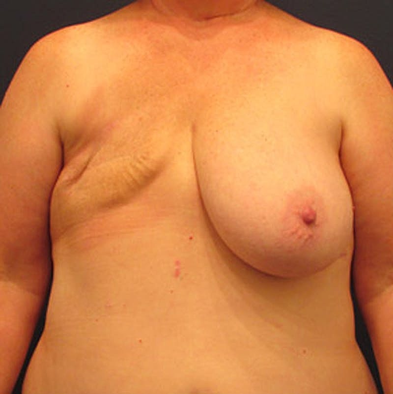 Breast Reconstruction Before & After
