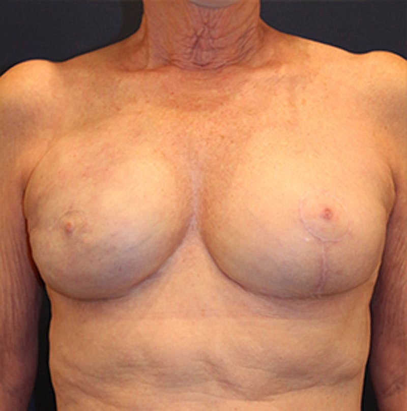 Breast Reconstruction Before & After